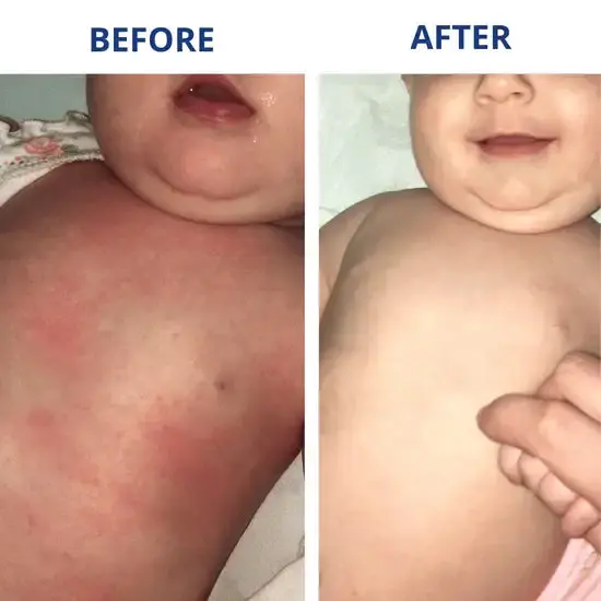 Eczema & Psoriasis Cream - Image 3