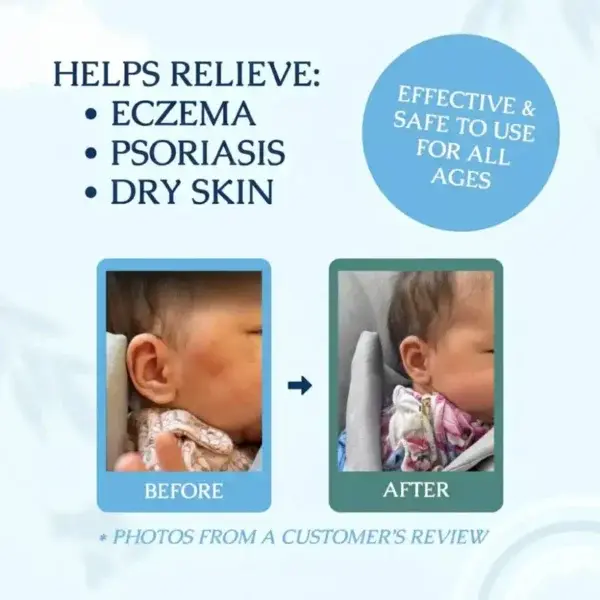 Eczema & Psoriasis Cream - Image 2