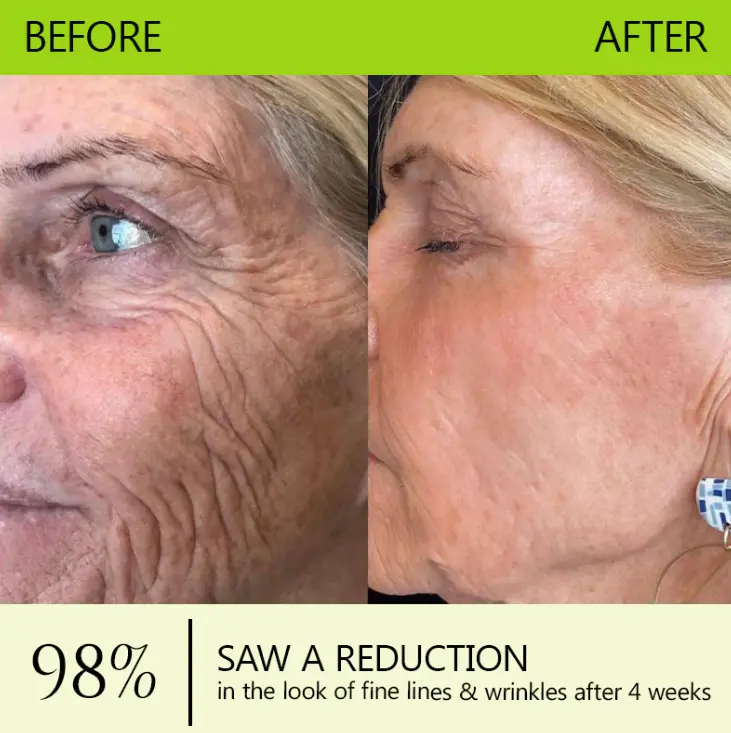 Botox & Retinol Shot - Image 3