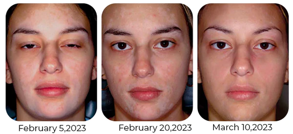 Vitiligo Therapy Cream - Image 7