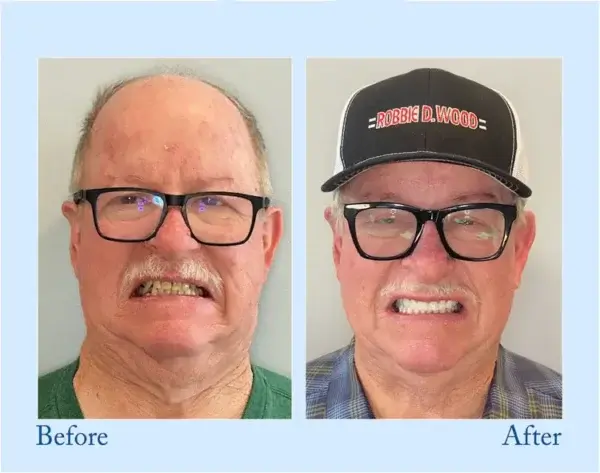 Custom-Fit Functional Dentures – Perfectly Fitted in Minutes at Home - Image 10