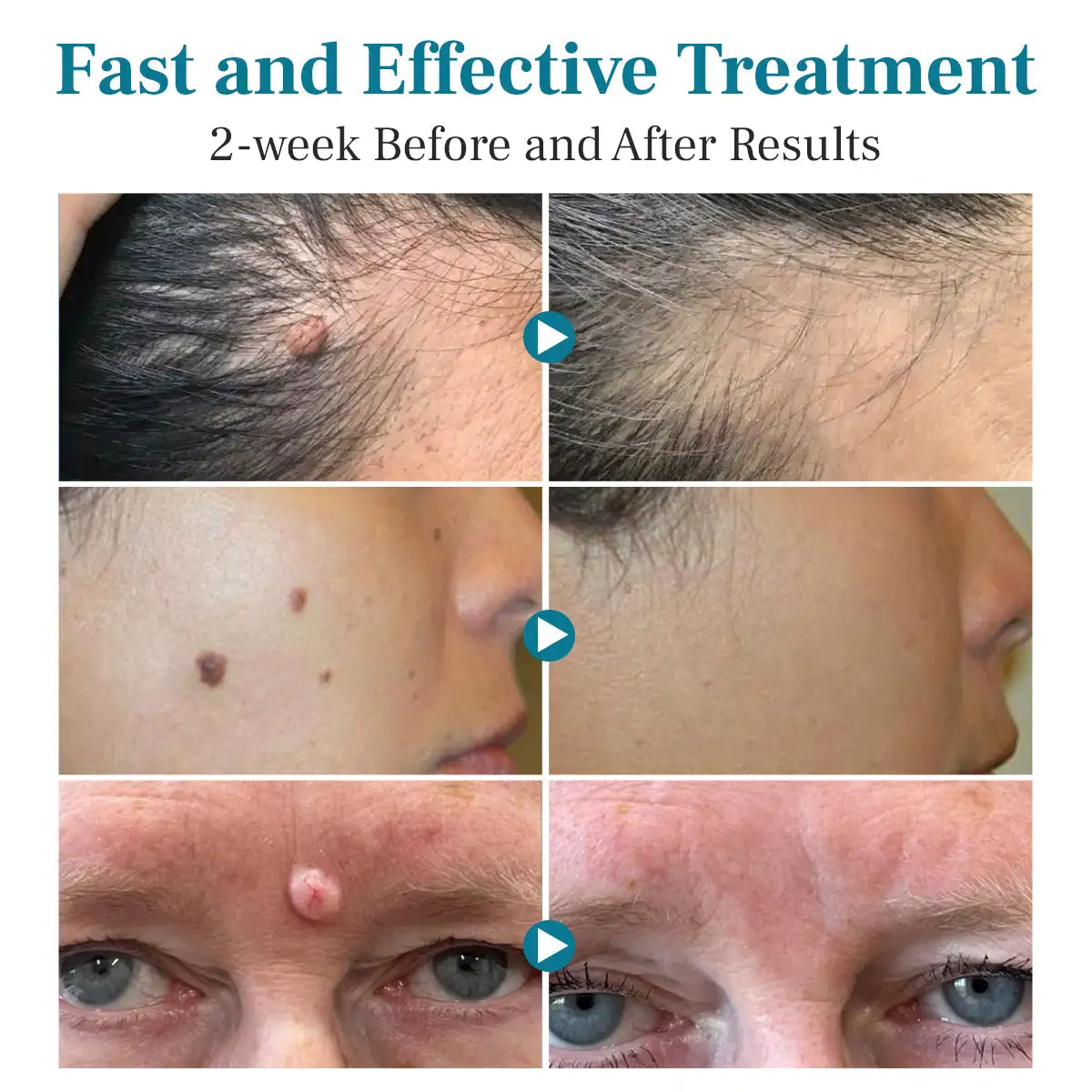 Non-invasive Mole and Wart Removal Laser Pen - Image 2