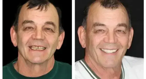 SmileFitPro Premium Denture - Image 11