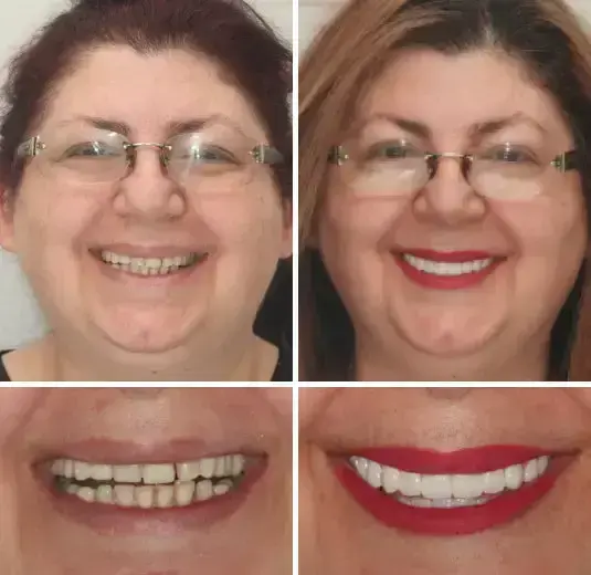 SmileFitPro Premium Denture - Image 7