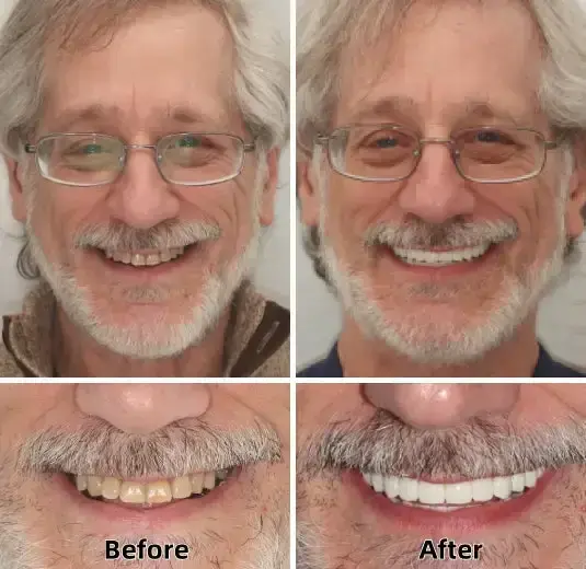 –Advanced Custom-Fit Functional Dentures - Image 5