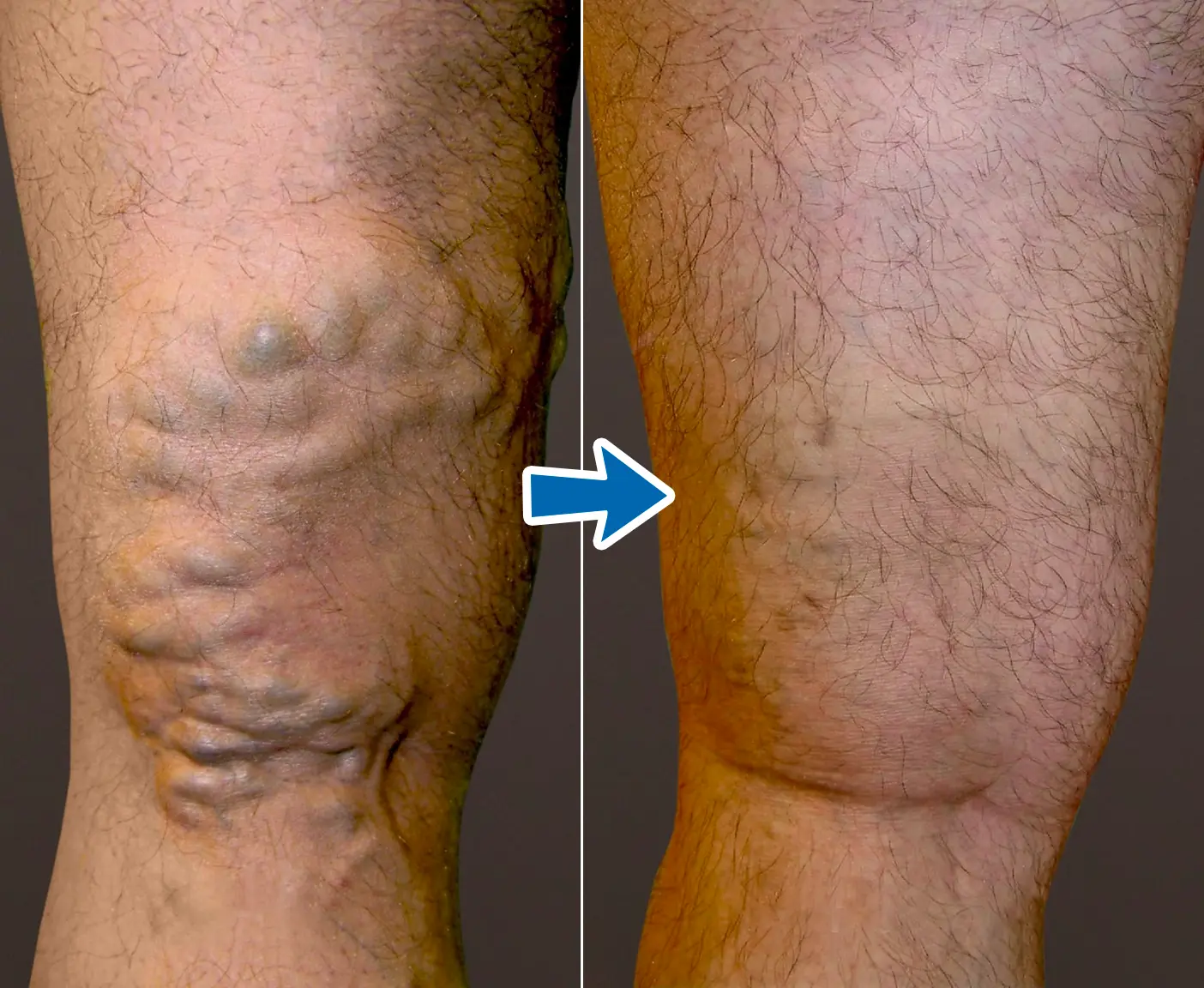 VenoAid Varicose Solution Spray - Image 5