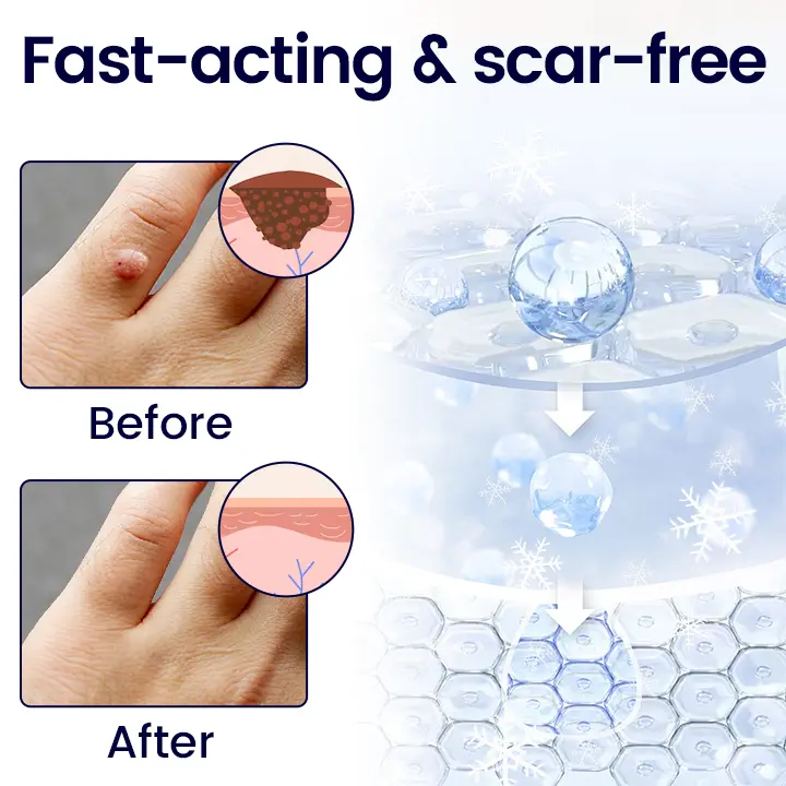 WartErase Cryo Freeze Spray - Image 5