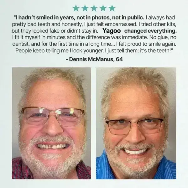 Medical Full Denture with Strong Suction - Image 7