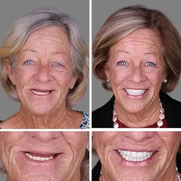 Medical Full Denture with Strong Suctiond - Image 11