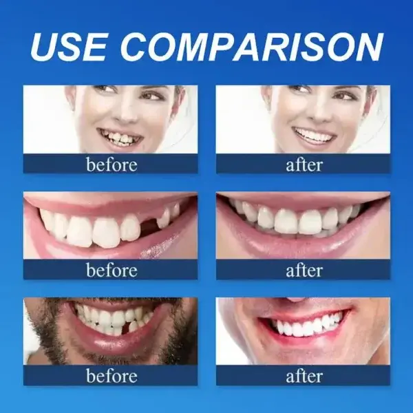 – Medical Full Denture with Strong Suctiond - Image 6