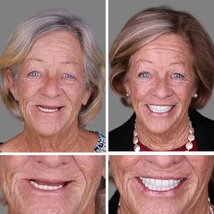 Medical Full Denture with Strong Suctiond - Image 9