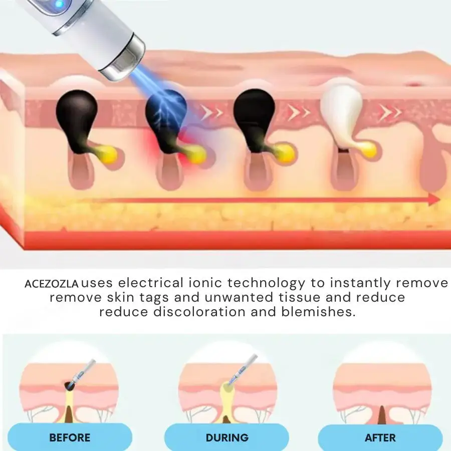 non-invasive laser pen delivers hospital-grade results at home - Image 4