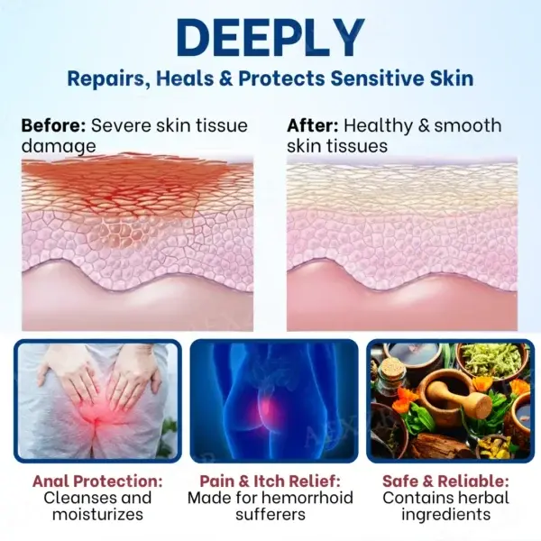Pruritus Ani Treatment Cream - Image 4