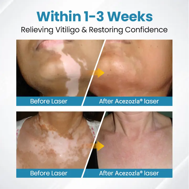 DermaBeam Vitiligo Therapy Device - Image 7