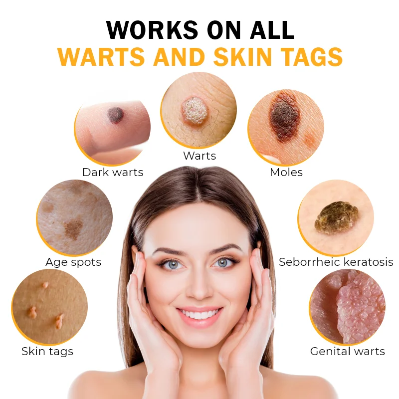 FlawlessFix Mole & Wart Removal Cream - Image 5