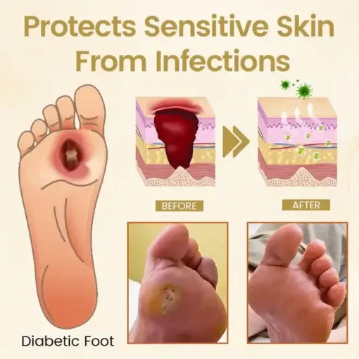 Bee Venom Diabetic Foot Healing Spray - Image 13