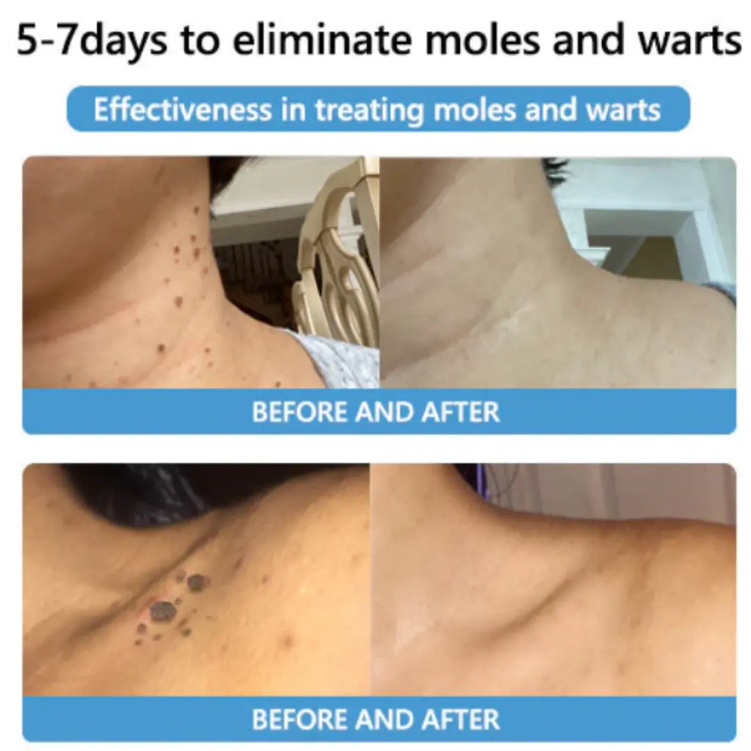 Bee Venom Mole and Wart Treatment Cream - LIMITED-TIME OFFER - Image 15