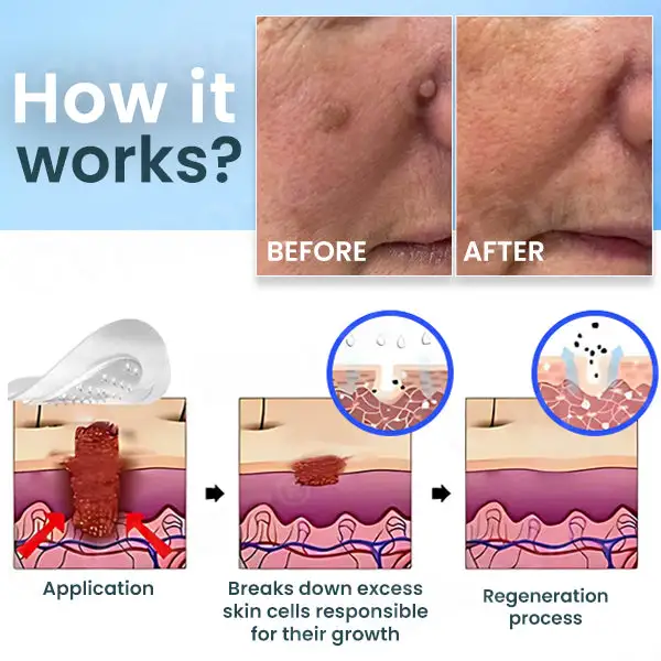 Nano-Micro Needle Skin Tags Removal Patches - Image 4