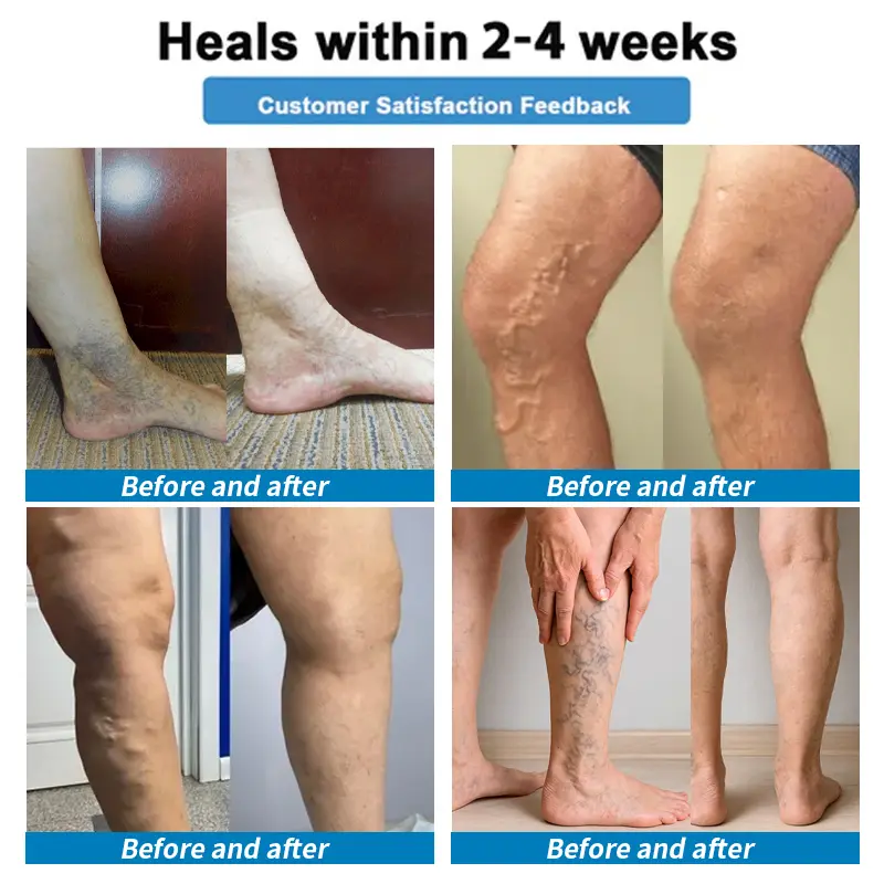 🛒4-in-1 Vein & Joint Nano Microneedle Advanced Therapy Patch🔥 - Image 5
