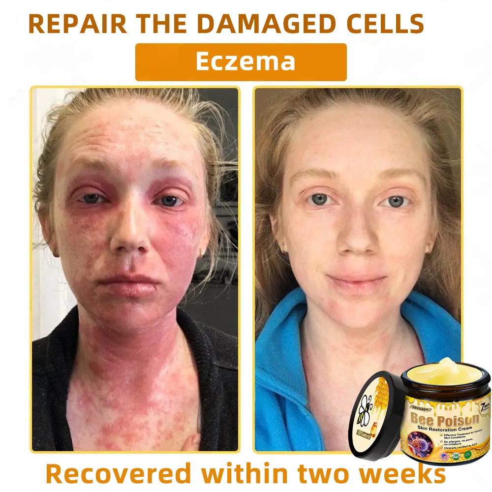 🐝Bee Poison Skin Restoration Cream 🐝 - Image 11