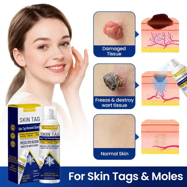 Skin Tag Renewal Spray- Reducing nutrient supply to damaged tissue and accelerating its natural shedding process - Image 7