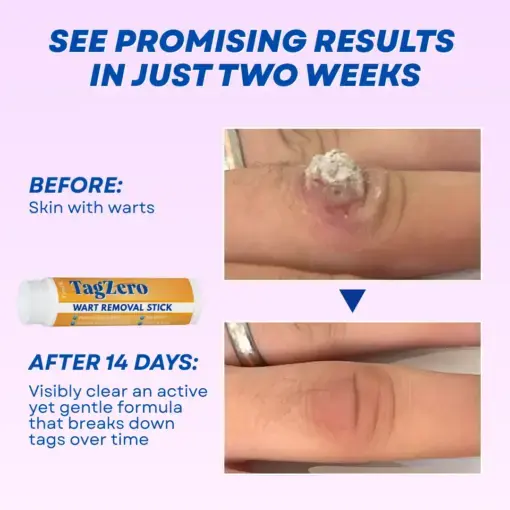 TagZero Wart Removal Stick - Image 2