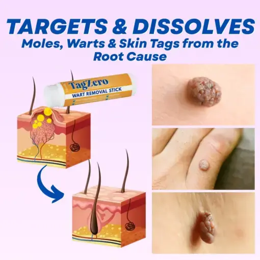 TagZero Wart Removal Stick - Image 4