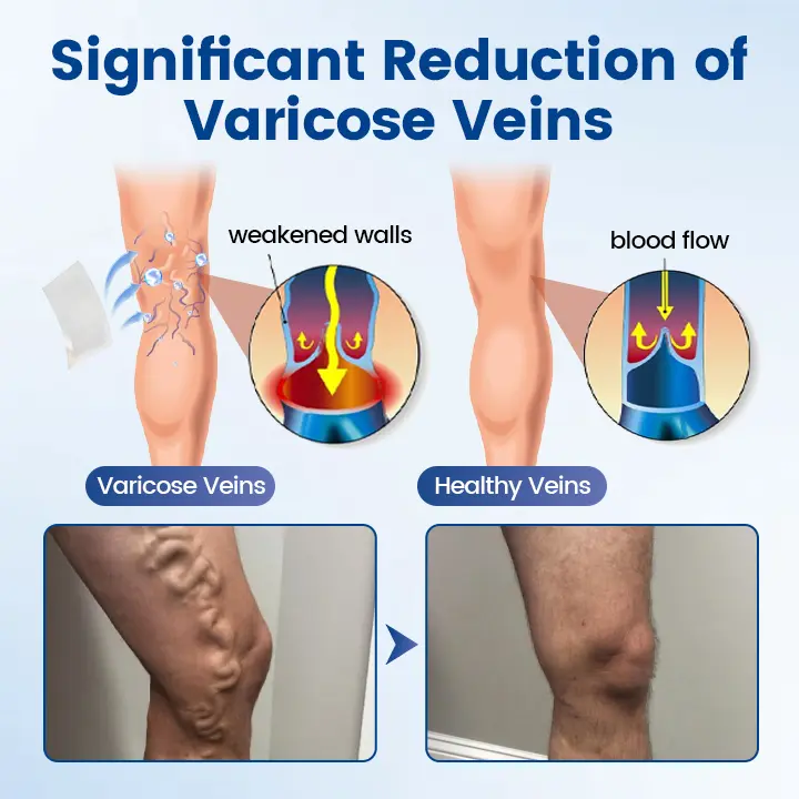 Vein Ease Microneedle Therapy Patch - Fast ⚡Effective 💪 and Non-Invasive 🚫 Treatment for Varicose Veins & Leg Swelling 👣 - Image 5