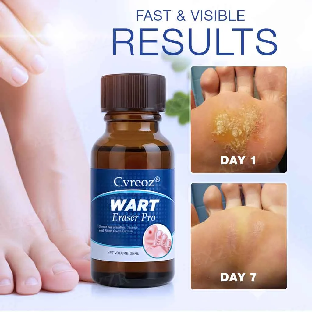 🔥Warts No More - 50% OFF | Wart Eraser Pro - Image 2