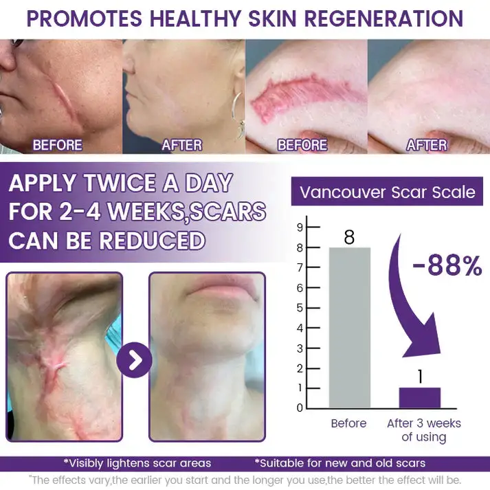 ReGenScar Rapid Recovery Scar Gel - Image 3