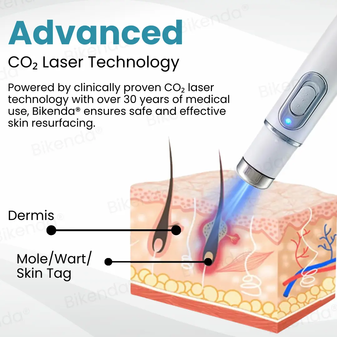 Non-invasive Mole and Wart Removal Laser Pen - Image 6