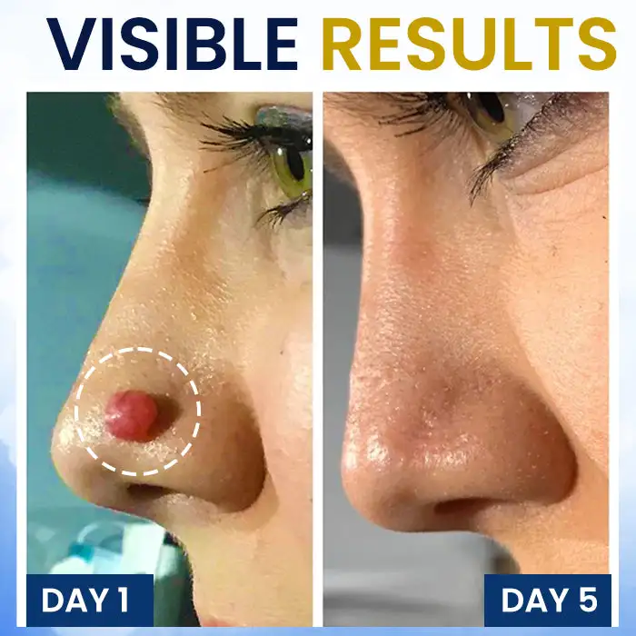Skin Tag Cryo Treatment Spray - Image 2