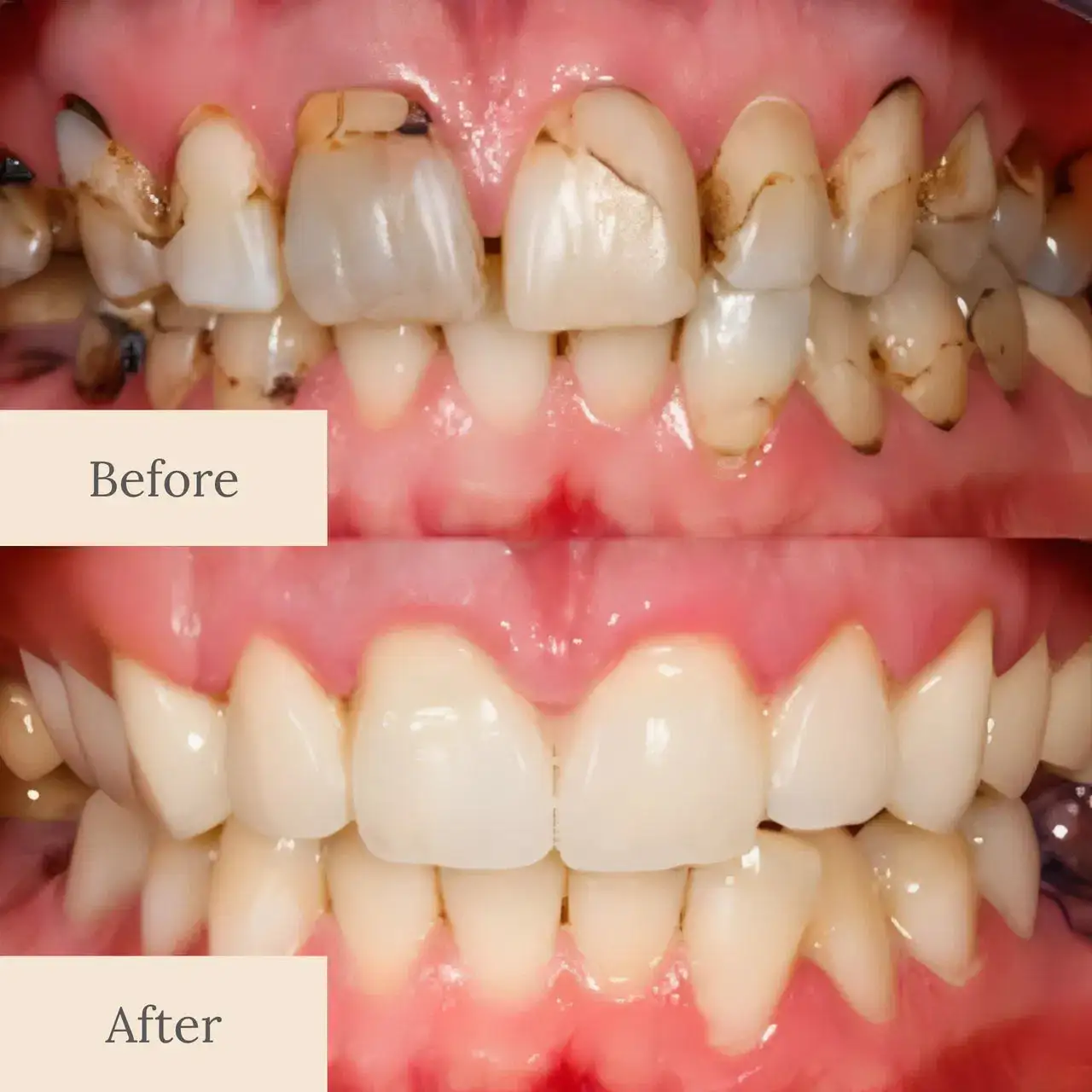 Enamel Repair & Teeth Whitening Kit - Image 8