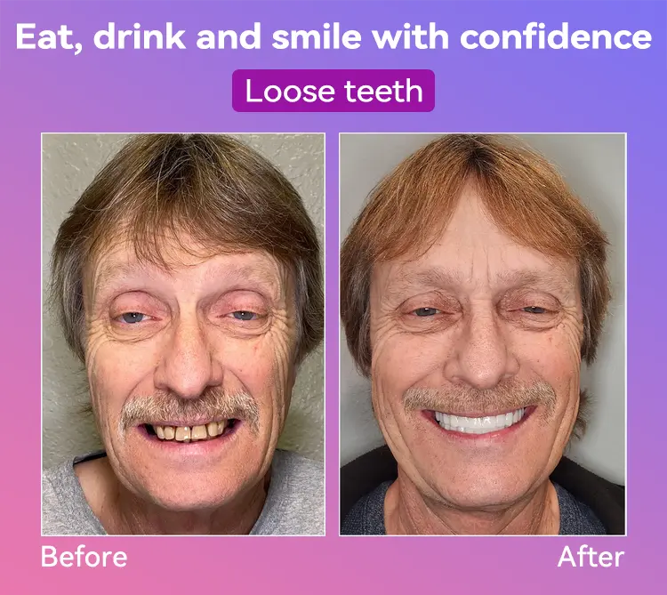 Latest Premium Comfort Dentures - Image 14