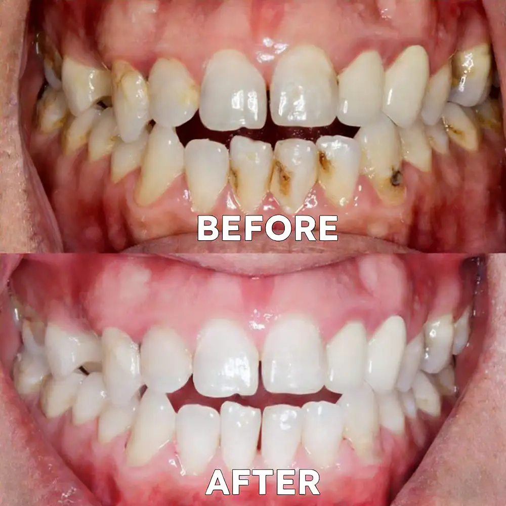 Fluoride-Free Nano Hydroxyapatite Tooth Powder - Image 6