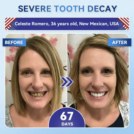 Tideglusib Fast‑Dissolving Tooth & Gum Repair Oral Strips - Image 5