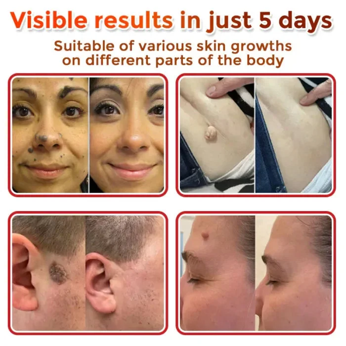 MicroNeedle Skin Growth Removal Patch - Image 4