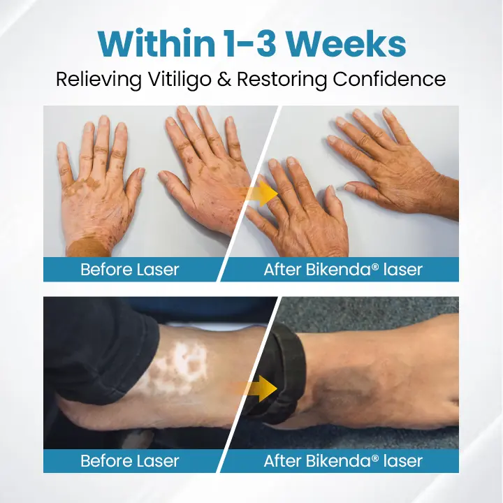 DermaBeam Vitiligo Therapy Device - Image 3