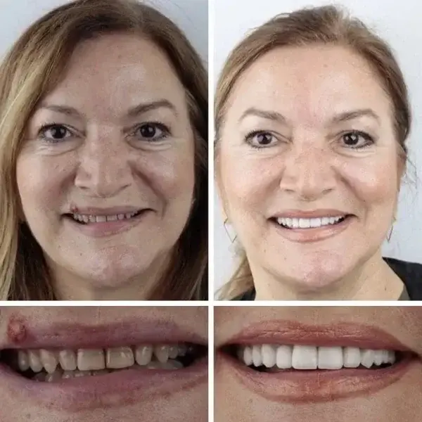 Premium Denture 2026 | Custom-Fit Dentures - Image 11
