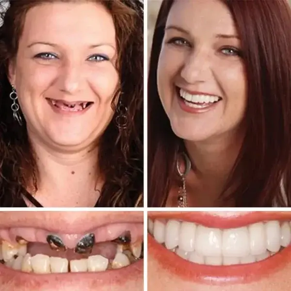 Premium Denture 2026 | Custom-Fit Dentures - Image 9