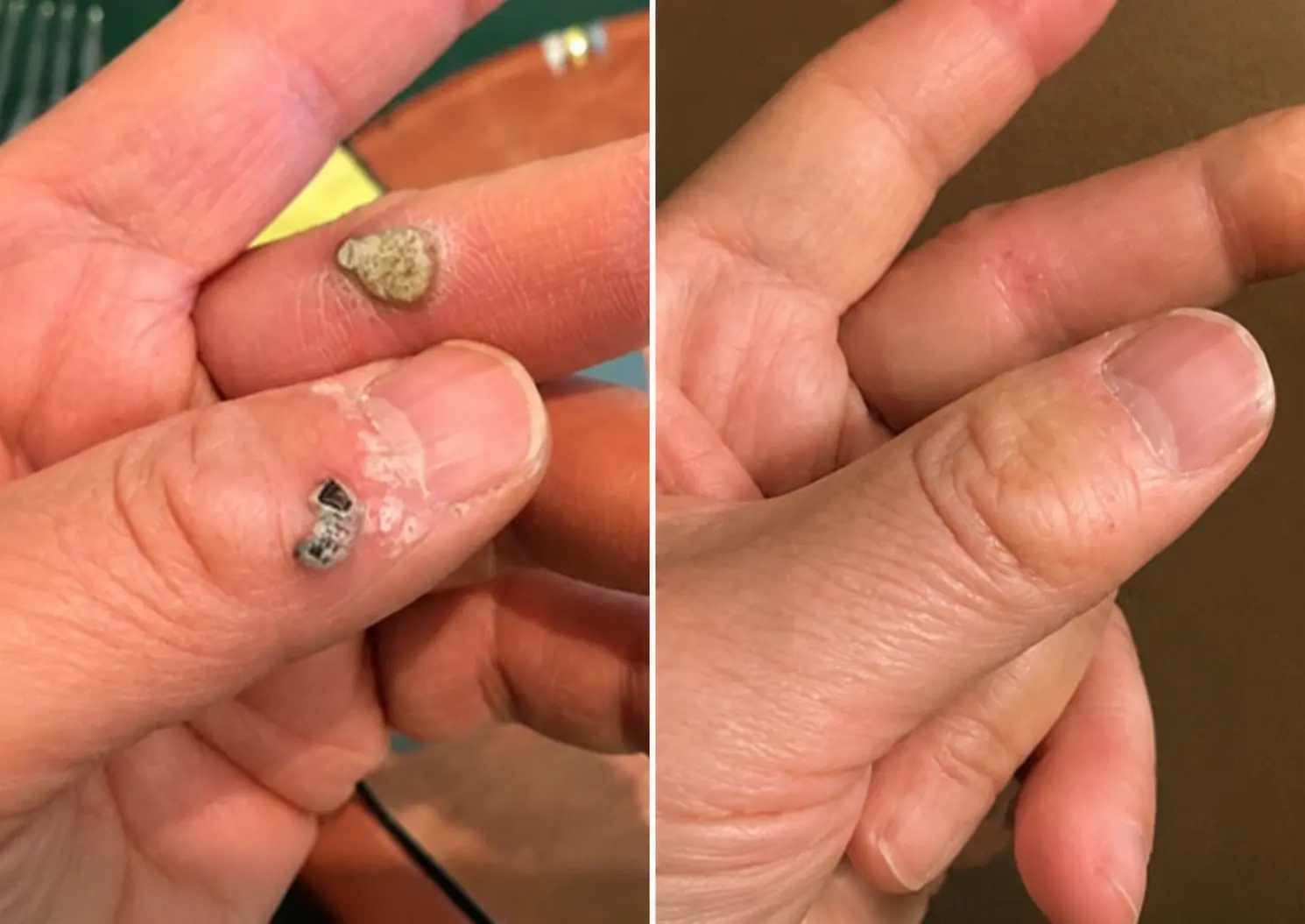 2-in-1 Microneedle & Hydrocolloid Patch - Image 5