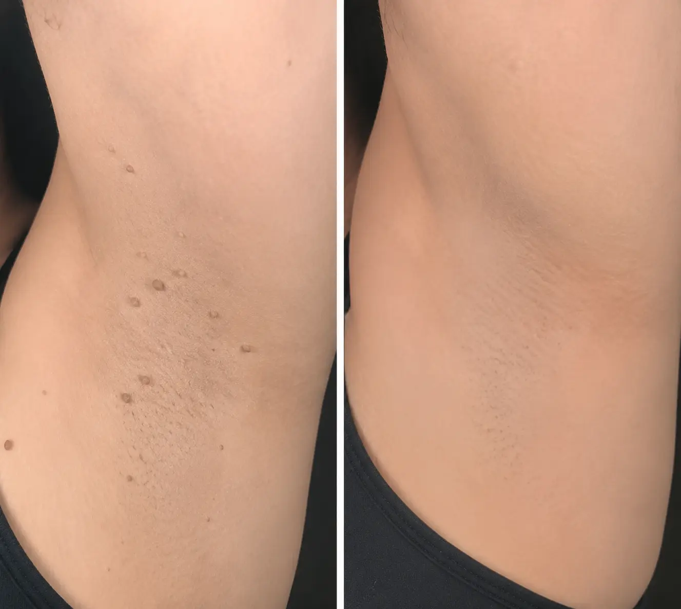 2-in-1 Microneedle & Hydrocolloid Patch - Image 8