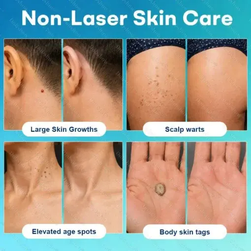 7 -Day Wart & Blemish Remover - Image 3