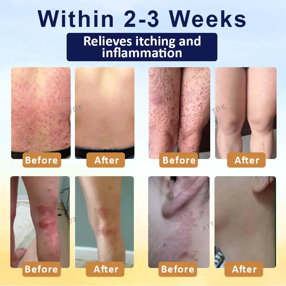 PsoriasisCare Mellifera Venom Skin Healing Spray - Image 2