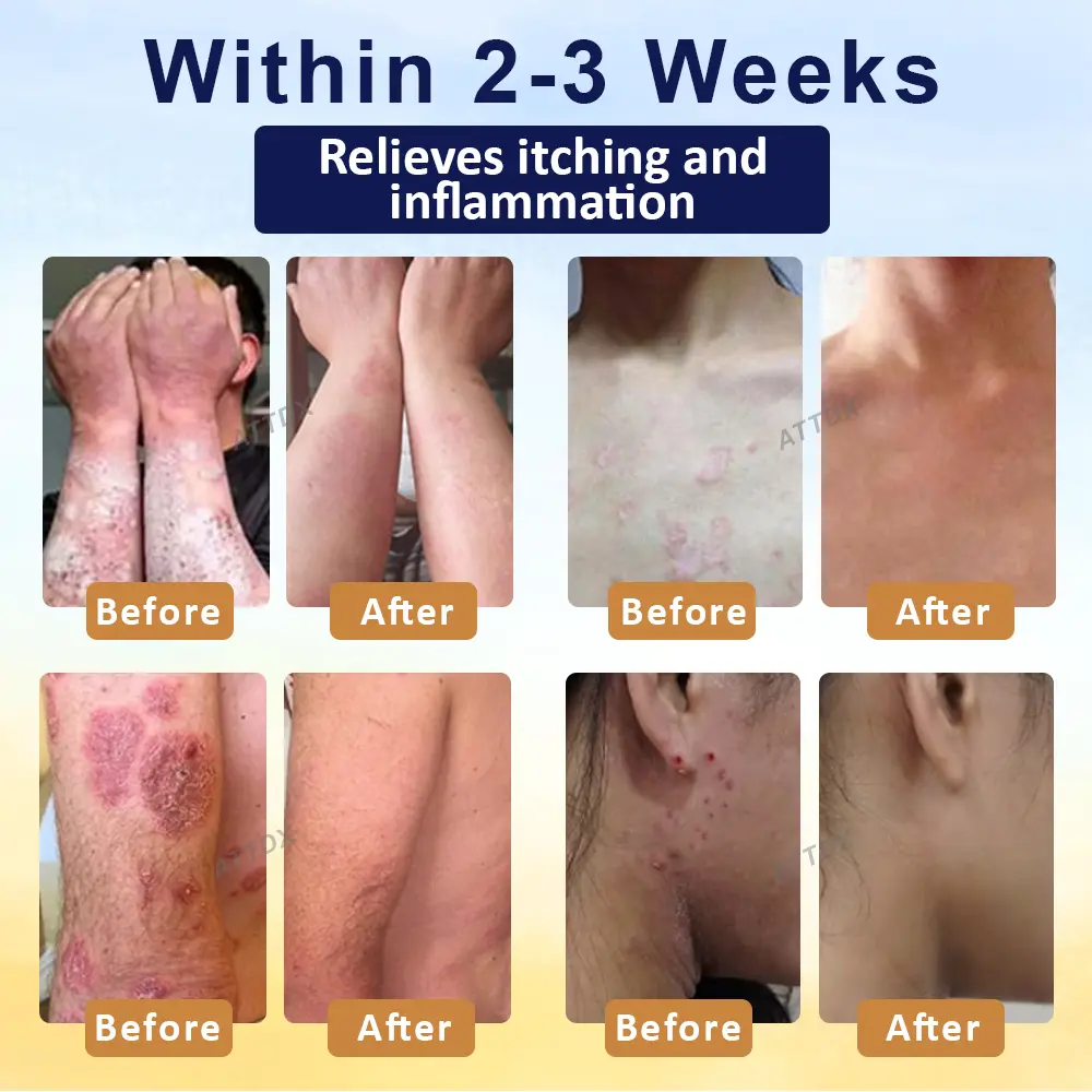 PsoriasisCare Mellifera Venom Skin Healing Spray - Image 3