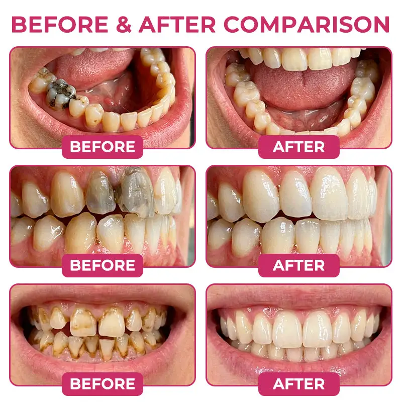 DenPerm Cavity-Repair Natural Enamel - Image 2